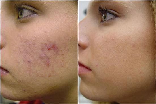Acne Scar Treatment Before and After Phtos