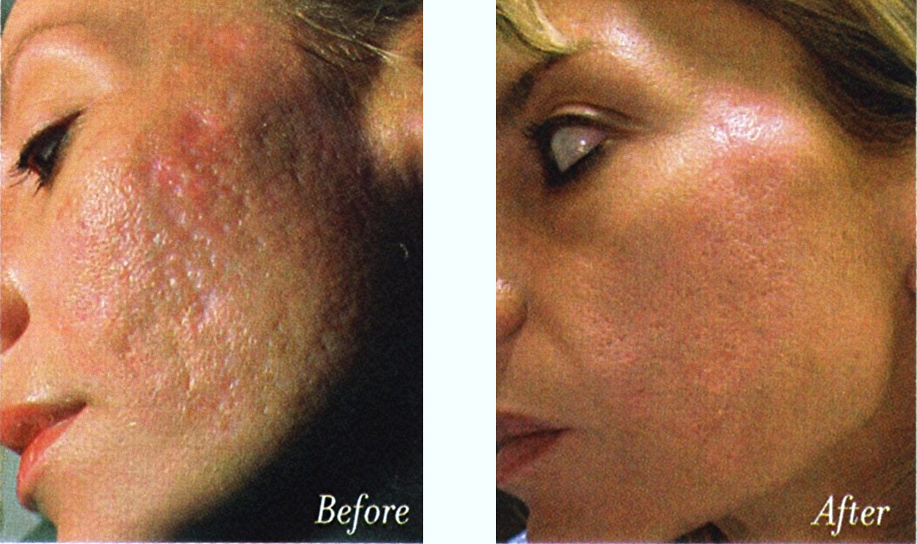 acne scars treatment before and after