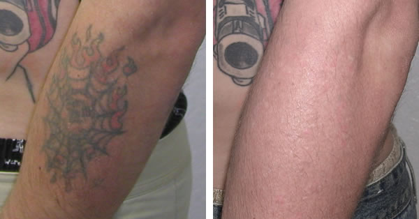 Tattoo Removal Before and After